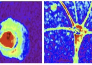 Advanced Imaging Technique to define healthy and diseased astrocytes